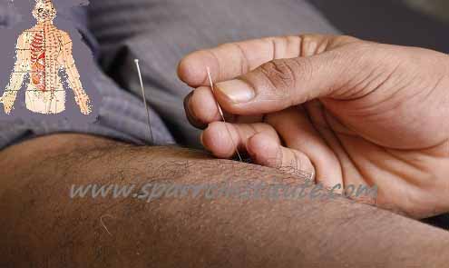 acupuncture-sparrc